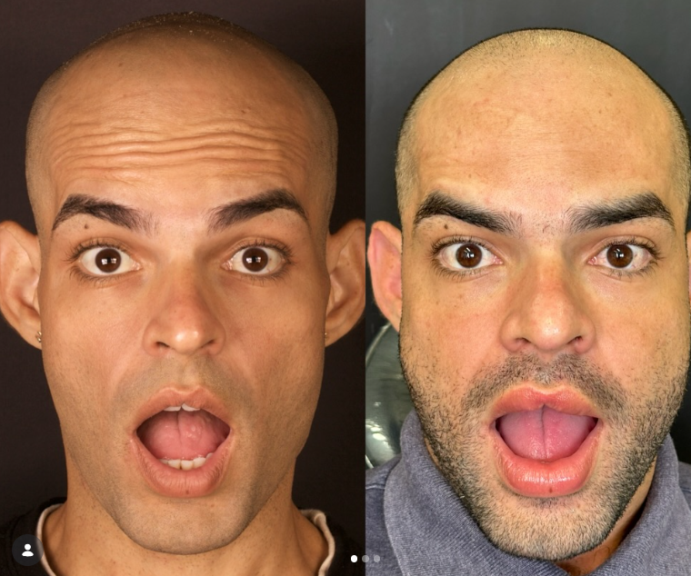 Antes e depois — procedimento 2